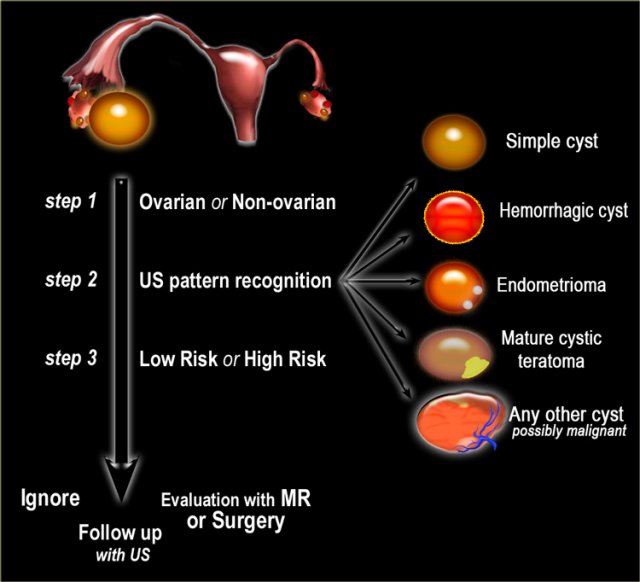 The Radiology Assistant : Roadmap to evaluate ovarian cysts