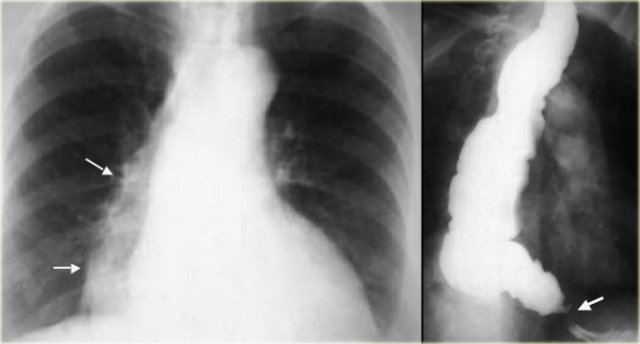 LEFT: Dilated esophagus (arrows) appears as long, well-defined structure paralleling heart RIGHT: Dilated esophagus usually deviates to right. Narrowing (arrow) at hiatus.