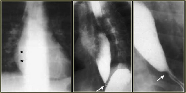 LEFT: Dilated esophagus (arrows) is projected behind right atrium.MIDDLE and RIGHT: Smooth, tapered narrowing just above diaphragm (arrows).