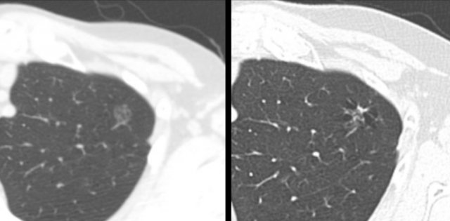 Example showing transition from pure ground glass (left panel) to cystic lung cancer morphology (right panel).