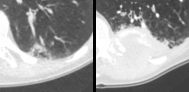 Multiloculated cystic lesion (left panel) interpreted as “non-specific”, despite a 6-month follow-up CT (for another reason) showed mild increase of ground glass, cystic air spaces and overall lesion size.  The next CT was obtained  for chest pain 2 years later, showing a large mass invading the chest wall (right panel). Patient died from metastatic lung adenocarcinoma.