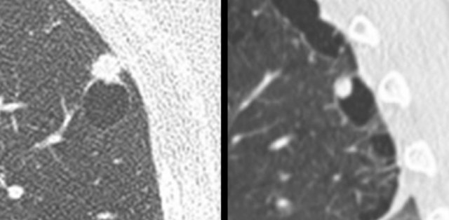 Examples of cystic lung cancer with an exophytic (left panel) and endophytic (right panel) solid component.