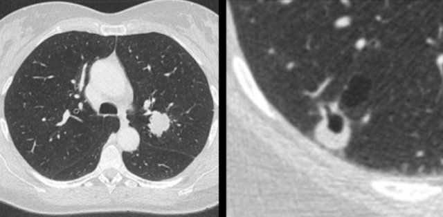 Patient with a T1c adenocarcinoma in the left upper lobe (left panel). Growing synchronous cystic lesion in the right lower lobe (right panel) that represented an unrelated second primary adenocarcinoma on histopathology. In daily practice
