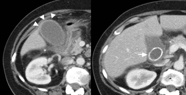 43-year-old woman with acute calculous cholecystitis.Contrast-enhanced CT shows a distended gallbladder (arrowheads) with a slightly thickened wall and subtle regional fat-stranding (asterix). There is an impacted obstructing stone in the neck of the gallbladder (arrow).