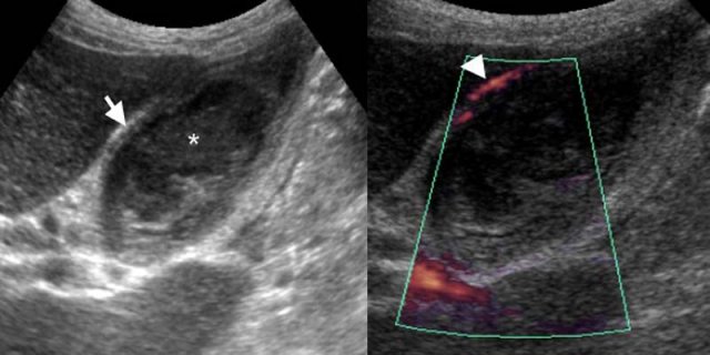 74-year-old man with acute acalculous cholecystitis. LEFT: US at the spot of maximum tenderness shows mural thickening of the gallbladder (arrow) that is completely filled with sludge (asterisk) without any stones. RIGHT: Power-Doppler sonography shows hypervascularity of the gallbladder wall (arrowhead), as a supporting sign of inflammation.