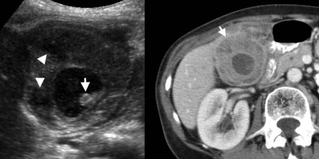 Xanthogranulomatous cholecystitis. LEFT: US shows marked wall thickening with intramural hypoechoic nodules (arrowheads), and an intraluminal stone (arrow).RIGHT: Contrast-enhanced CT shows a deformed and thickened gallbladder wall containing hypoattenuating nodules
