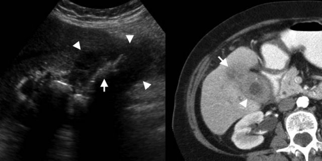 LEFT: Gallbladder carcinoma. US shows marked generalized wall thickening (arrowheads), replacing the gallbladder lumen. Multiple gallbladder stones (arrow) indicate the probable location of the filled lumen.RIGHT: Contrast-enhanced CT depicts a thick-walled gallbladder (arrowhead), with local infiltration of the mass in the adjacent liver (arrow).