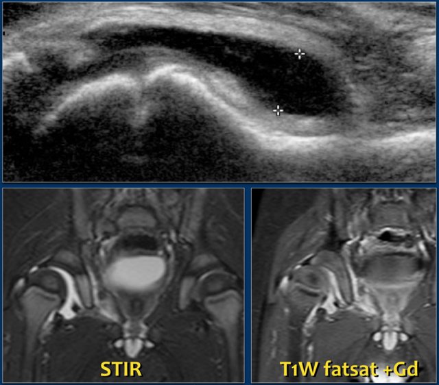 JIA: Effusion of the right hip in JIA. The synovium is thickened and loads Gadolineum contrast (right). Images courtesy of Dr LS Ording Muller