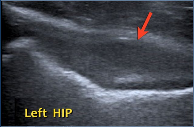 Five-year old boy with a limp and fever at presentation. Ultrasound was difficult because the boy was unable to stretch his leg, but the left hip clearly shows an effusion and synovial thickening. Pus was evacuated in the operating theater.