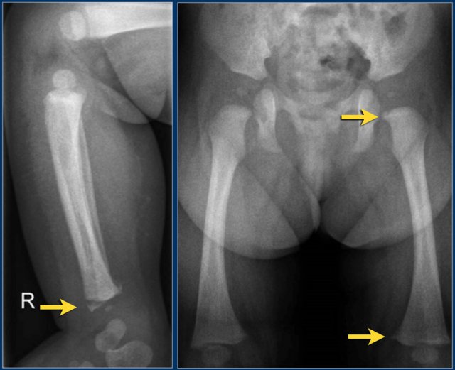 Corner fractures in a case of child abuse
