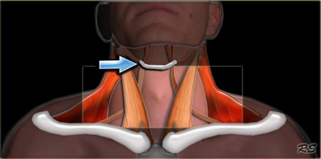 The infrahyoid neck is separated from the suprahyoid neck by the hyoid bone (arrow)