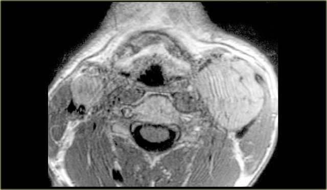 Paraganglioma: T1-weighted Gadolineum enhanced MR image at the level of the supraglottic larynx