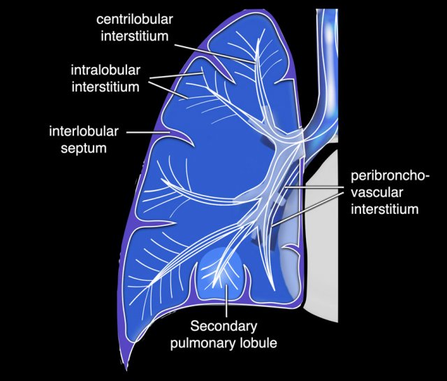 Lung anatomy showing secondary lobules and the axial and peripheral interstitium.