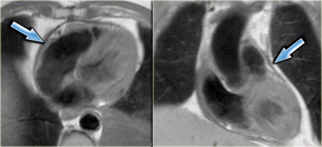 Axial and coronal black-blood images of a patient with constrictive pericarditis after CABG. Arrows point to the thickened pericardium.