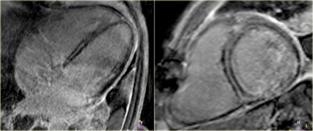Idiopathic dilated cardiomyopathy with midwall septal enhancement, consistent with fibrosis