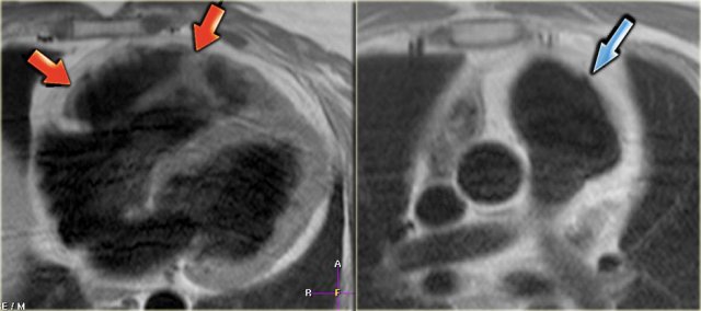 Left: fatty infiltration in the myocardium of the anterior wall of the dilated right ventricle (arrows) Right: dilated right ventricular outflow tract with micro-aneurysm (arrow).