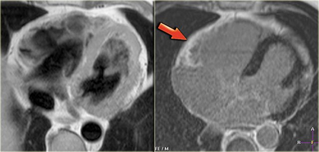 Left: axial black-blood image of a patient with fibro-fatty ARVC Right: late enhancement image shows enhancement of the anterior wall of the right ventricle (arrow).