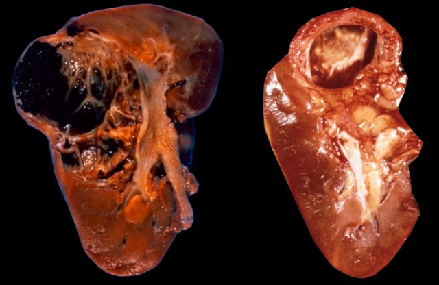 Even on gross examination a  cystic renal cell carcinoma  (left) may be indistinguishable from a complicated cyst (right)