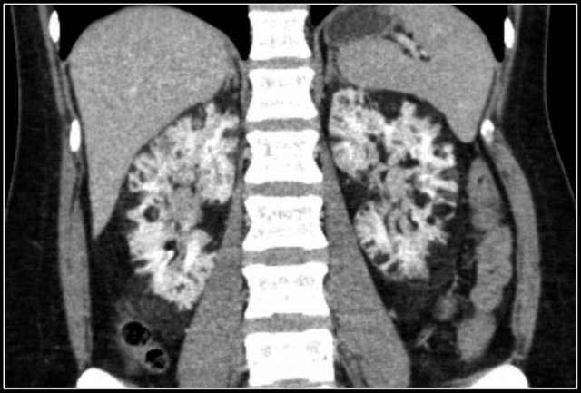 Multiple Angiomyolipomas in a patient with tuberous sclerosis.