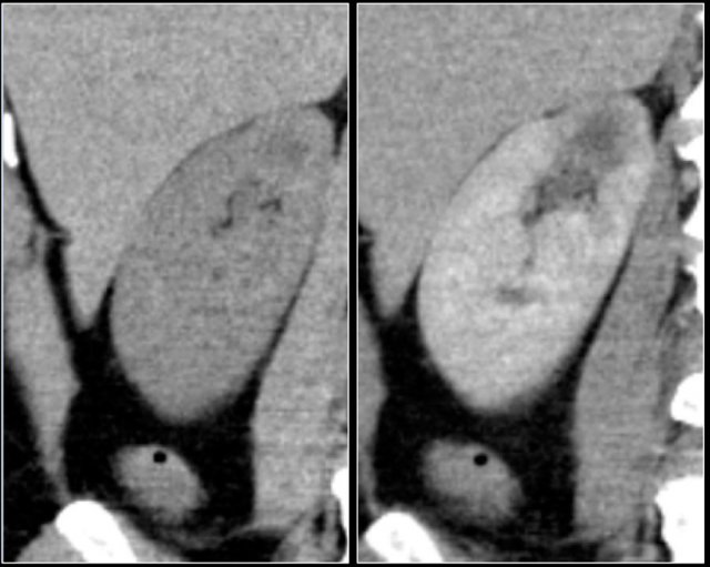 Infiltrative lesion in the upper pole of the right kidney, hardly visible on the unenhanced image on the left, clearly visible in the nephrogenic phase shown on the right. PA showed clearcell RCC
