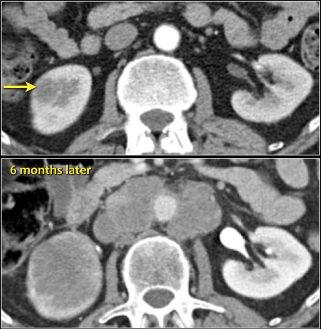 Infiltrative lesion in the lower pole of the right kidney, which has considerably grown six months later, with extensive lymphadenopathy. This turned out to be a metastasis of a lungcarcinoma.