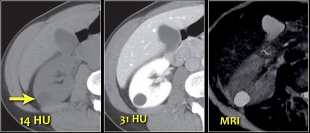 Pseudo-enhancement in a renal cyst.