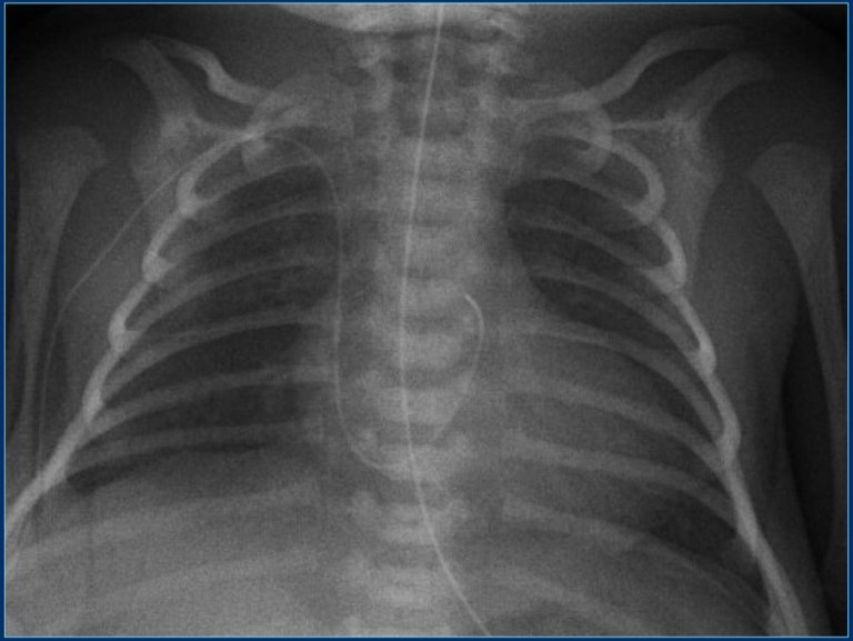 The Radiology Assistant : Lines and tubes in Neonates