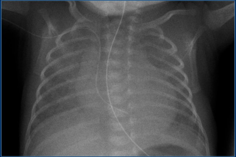 The Radiology Assistant : Lines and tubes in Neonates