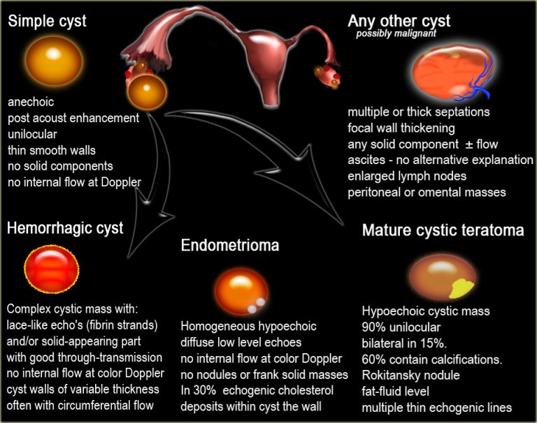 The Radiology Assistant : Endometriosis - MRI Detection