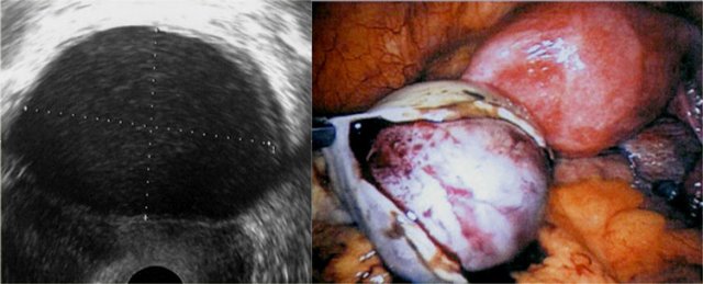 Endometrioma at ultrasound and laparoscopy