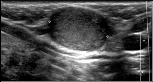 Typical hyper-echoic dermoid cyst in the suprasternal notch.