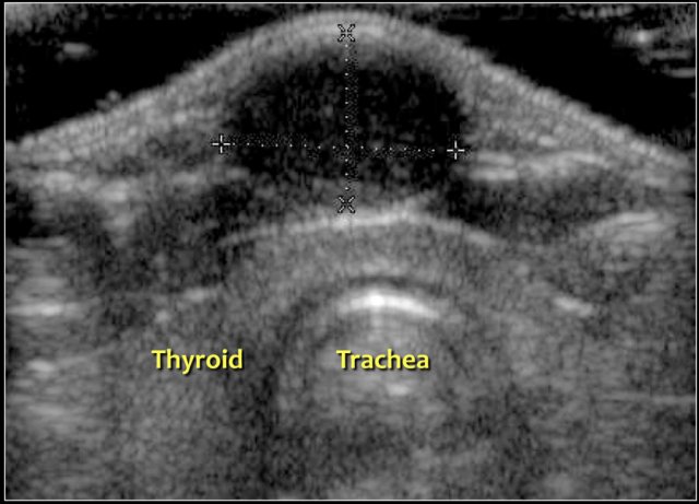 Thyroglossal duct cyst