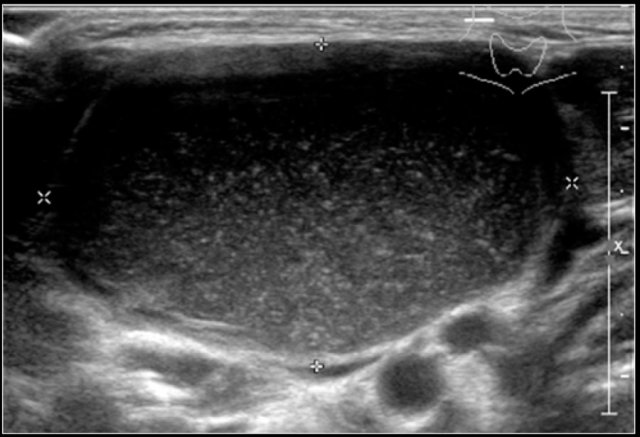 Typical ultrasound appearance of a branchial cleft cyst with echogenic debris.