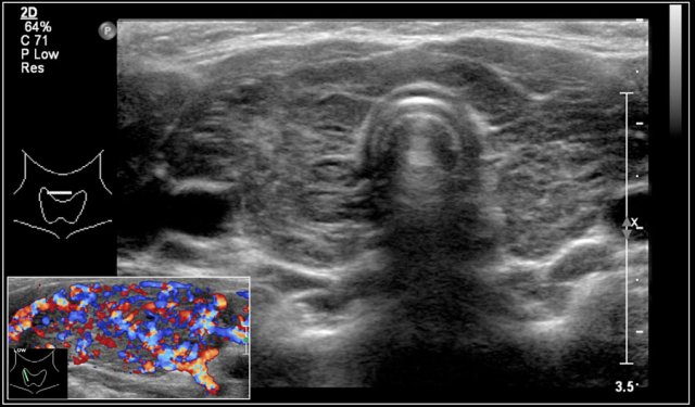 Hashimoto's thyroiditis: An enlarged thyroid gland with a diffuse inhomogeneous structure and hyperemia is seen in a ten-year-old girl