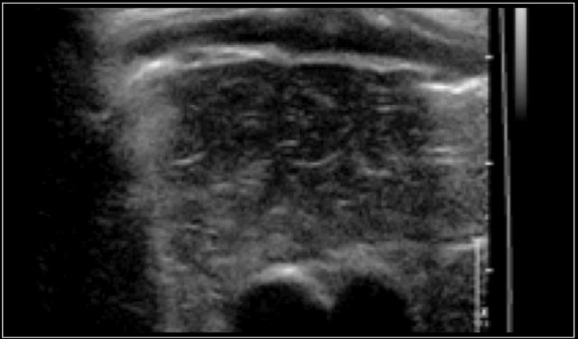 Ultrasound image of the thymus in a two-months-old boy.
