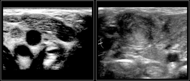 LEFT: normal sternocleidomastoid muscle. RIGHT: Hyperechoic mass in sternocleidomastoid muscle.