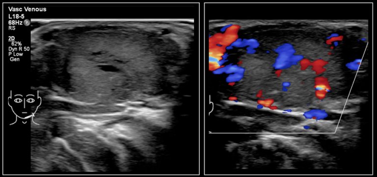 The Radiology Assistant : Neck Masses In Children