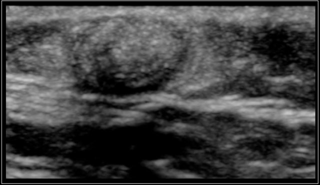 Firm tumor in the right temporal area of a 2-year-old boy. Ultrasound shows an echogenic lesion with a well demarcated wall and slight posterior shadowing, characteristic for a pilomatrixoma.
