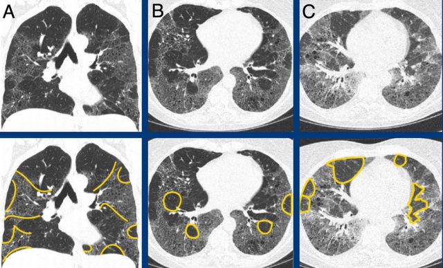 pulmonary fibrosis