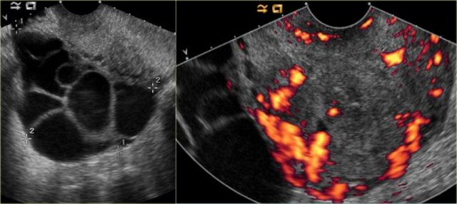 Theca lutein cysts: US images of a young pregnant woman. In both ovaries there are multiple cysts. Right image shows an invasive uterine mass, consistent with invasive molar pregnancy.