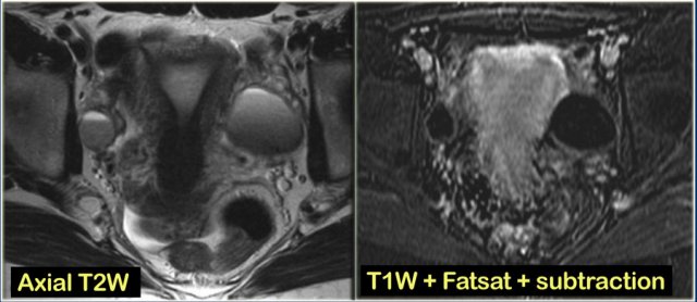 Hemorrhagic ovarian cyst. Left:image without subtraction. Right: image with subtraction.