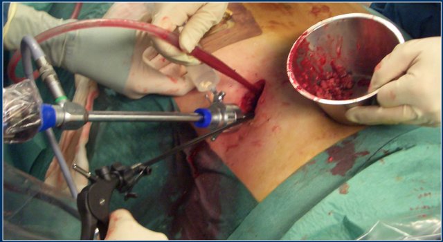 Videoscopic assisted retroperitoneal debridement (VARD)