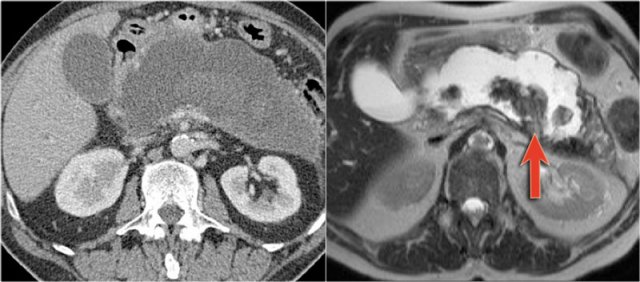 MRI shows dependant debris in pseudocyst