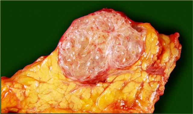 Serous cystic neoplasm with cmultiple small cysts. Courtesy of Dr Allen, HPB surgery, Memorial Sloan Kettering Cancer Center, NY