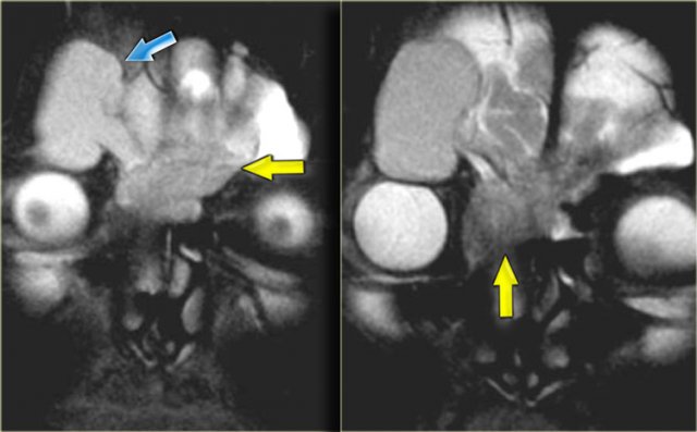 Mucocele  (blue arrow) secondary to obstructing tumor (yellow arrow)