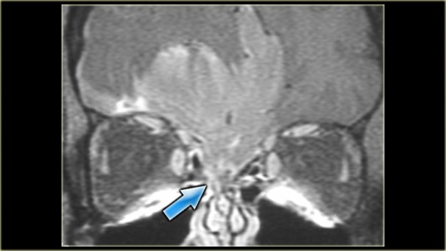 Transcranial spread of meningioma