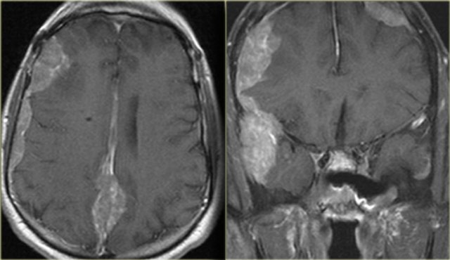 Recurrence of carcinoma with dural implants bilaterally