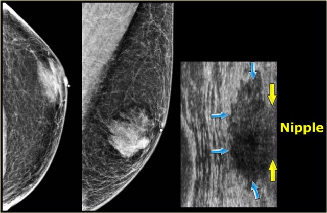 Mammogran and rotated ultrasound image