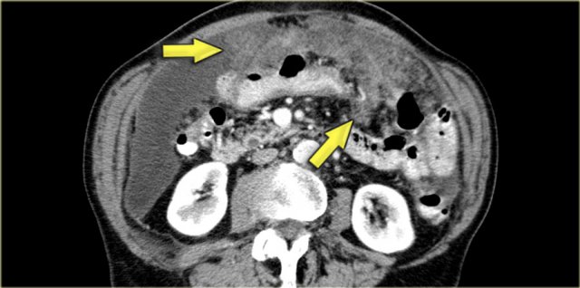 Omental cake (arrows) and ascites in a patient with peritoneal metastases