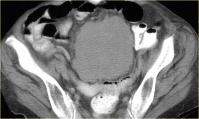 Metastasis of a lung carcinoma presenting as a solitary solid peritoneal mass